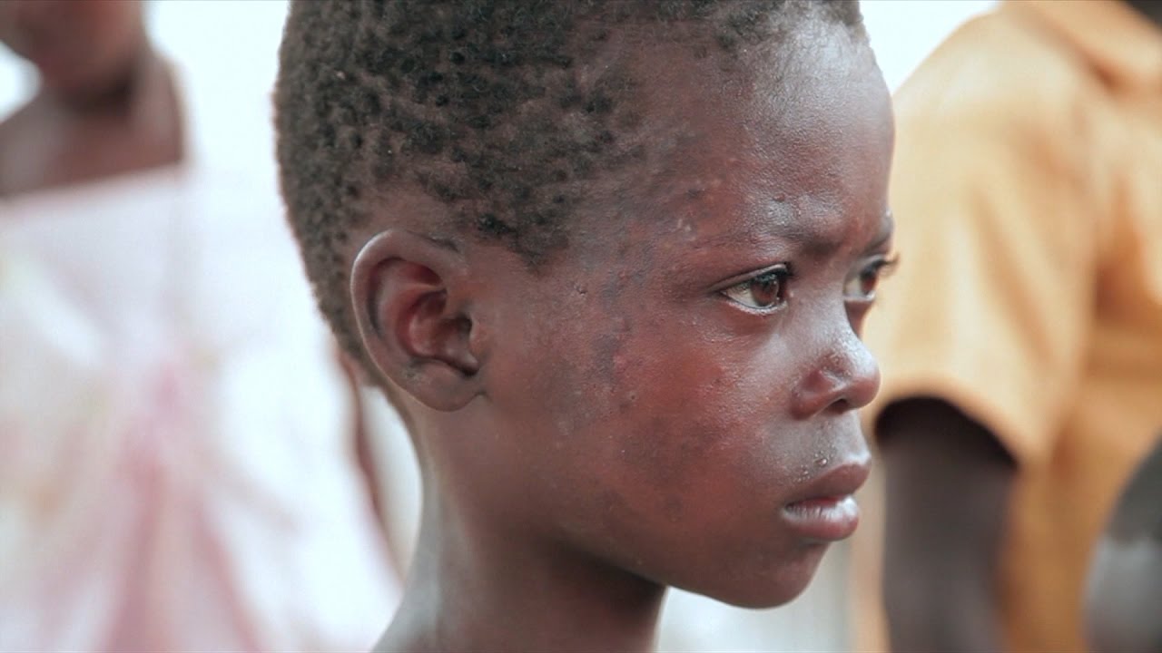 Neglected Tropical Diseases: A Global Challenge and the Progress in Addressing It